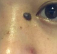 火箭军总医院整形外科手术祛痣怎么样？真实去痣经历分享