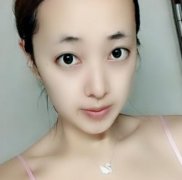 北京空军总医院整形美容中心玻尿酸填充泪沟日记分享，对比照