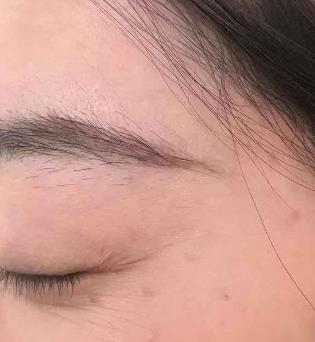 烟台京韩整形美容医院去眼角纹怎么样?真实术后恢复照片