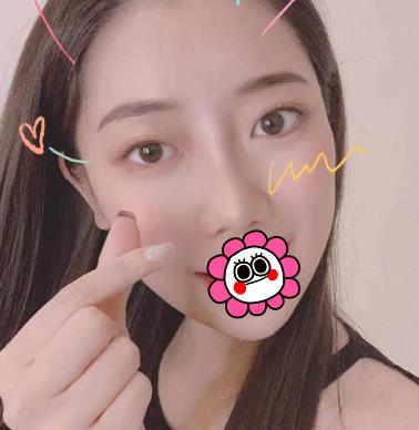 烟台京韩整形美容医院去眼角纹怎么样?真实术后恢复照片