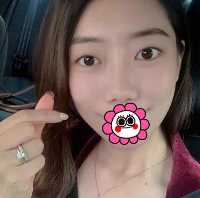 烟台京韩整形美容医院去眼角纹怎么样?真实术后恢复照片