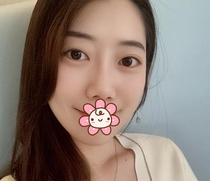 烟台京韩整形美容医院去眼角纹怎么样?真实术后恢复照片