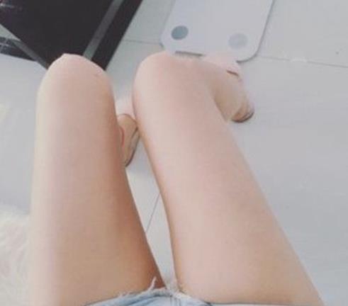 哈尔滨斯美诺抽脂怎么样？大腿吸脂90开真实案例分享