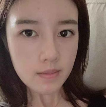 长春珍妮整形美容医院隆鼻修复案例反馈，果较为满意