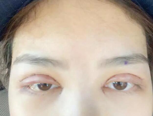 唐都医院李望舟做双眼皮怎么样？真实双眼皮案例分享