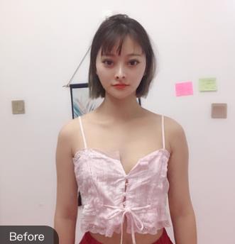 武汉五洲莱美余国胜自体脂肪丰胸真实案例分享,恢复过程,对比照
