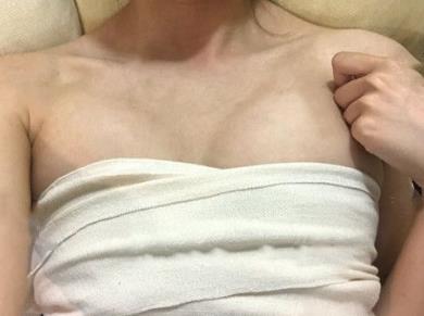 南京施尔美整形医院自体脂肪丰胸多少钱?真实丰胸经验分享