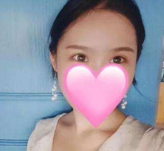 北京东方和谐做双眼皮怎么样？真人案例展示医生技术