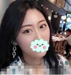 萍乡丽芙整形医院双眼皮怎么样？我真实的双眼皮恢复经验