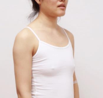 北京东方和谐自体脂肪隆胸果怎么样？看看冯斌医生的真实手术案例吧。