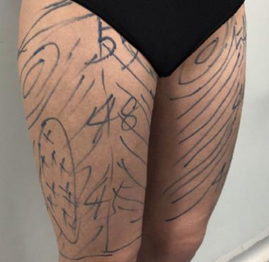 北京协和医院整形大腿吸脂怎么样？真实没问题反馈果较为好