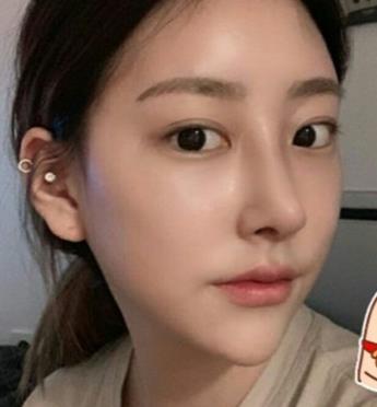 西南医院整形美容科双眼皮案例果分享，从此就是小仙女儿了。