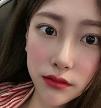 西南医院整形美容科双眼皮案例果分享，从此就是小仙女儿了。