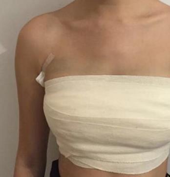 深圳北大崔永言医生隆胸怎么样？真实术后果图一览！