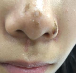 宜昌市中医医院整形科祛疤多少钱?真实恢复经验分享