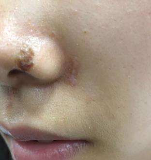 宜昌市中医医院整形科祛疤多少钱?真实恢复经验分享