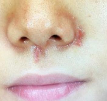 宜昌市中医医院整形科祛疤多少钱?真实恢复经验分享