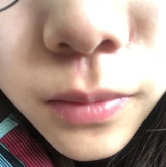 宜昌市中医医院整形科祛疤多少钱?真实恢复经验分享