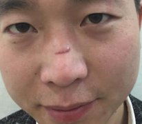 烟台毓璜顶医院整形美容科去疤痕怎么样？真人案例果分享