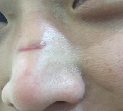 烟台毓璜顶医院整形美容科去疤痕怎么样?真人案例果分享