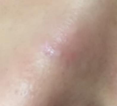 烟台毓璜顶医院整形美容科去疤痕怎么样?真人案例果分享