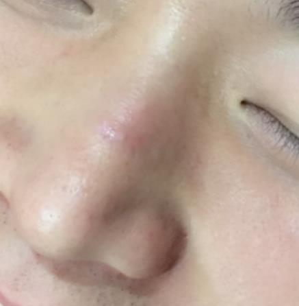 烟台毓璜顶医院整形美容科去疤痕怎么样?真人案例果分享