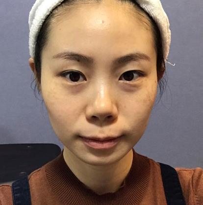 枣庄市立医院整形科去疤痕多少钱?手术果恢复过程一览