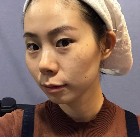 枣庄市立医院整形科去疤痕多少钱?手术果恢复过程一览