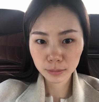 枣庄市立医院整形科去疤痕多少钱?手术果恢复过程一览