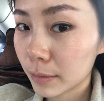 枣庄市立医院整形科去疤痕多少钱?手术果恢复过程一览