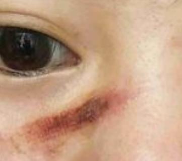 宜昌市人民医院美容科去疤痕怎么样?我的祛疤过程分享