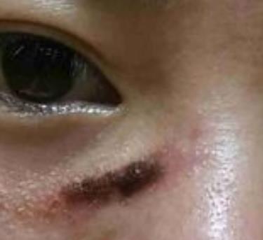 宜昌市人民医院美容科去疤痕怎么样?我的祛疤过程分享