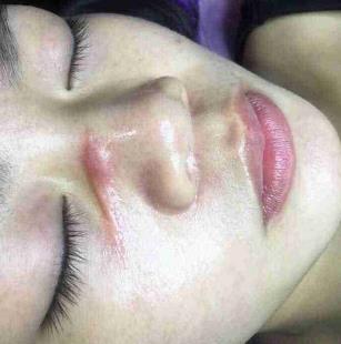 宜昌市人民医院美容科去疤痕怎么样?我的祛疤过程分享