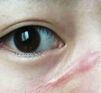 宜昌市人民医院美容科去疤痕怎么样?我的祛疤过程分享