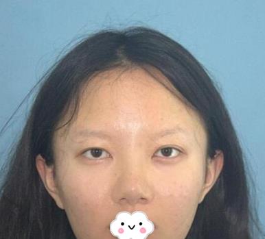 北京八大处双眼皮案例,图片直击术后恢复过程,果