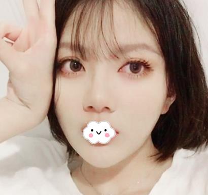 北京八大处双眼皮案例,图片直击术后恢复过程,果