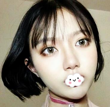 北京八大处双眼皮案例,图片直击术后恢复过程,果