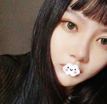 北京八大处双眼皮案例,图片直击术后恢复过程,果