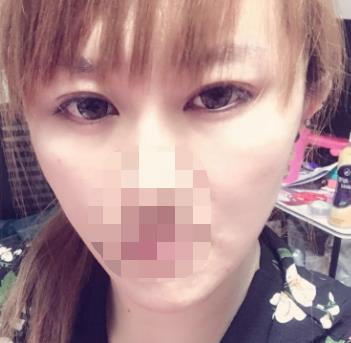 济南华美整形医院双眼皮怎么样?术后恢复过程分享