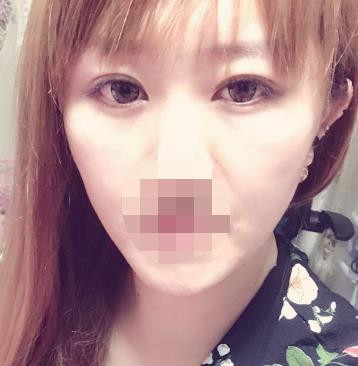 济南华美整形医院双眼皮怎么样?术后恢复过程分享