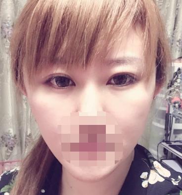 济南华美整形医院双眼皮怎么样?术后恢复过程分享