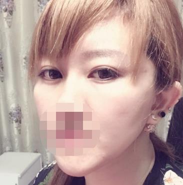 济南华美整形医院双眼皮怎么样?术后恢复过程分享