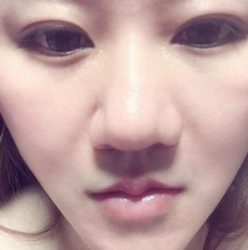 济南名流美容整形医院脂肪填充面部怎么样?真实案例对比图分享