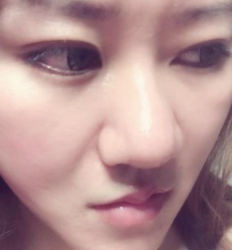 济南名流美容整形医院脂肪填充面部怎么样?真实案例对比图分享