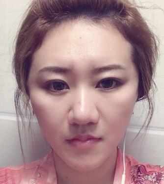 济南名流美容整形医院脂肪填充面部怎么样?真实案例对比图分享