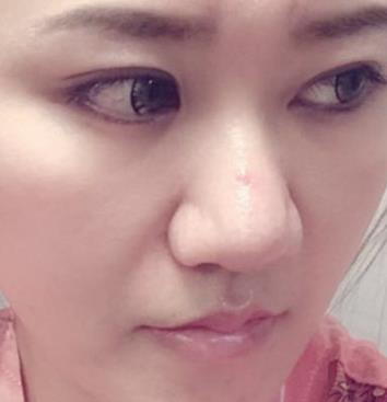 济南名流美容整形医院脂肪填充面部怎么样?真实案例对比图分享