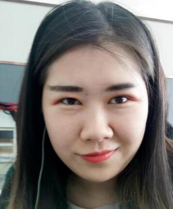 上海华美双眼皮案例果图分享,真实割双眼皮经历