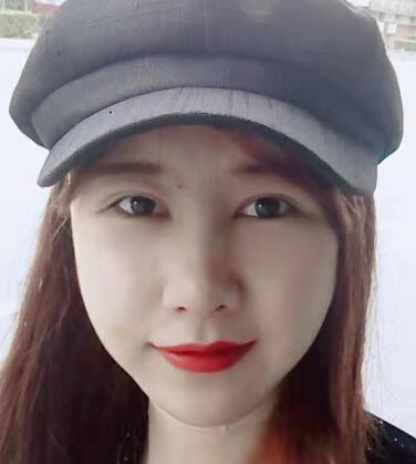 上海华美双眼皮案例果图分享,真实割双眼皮经历