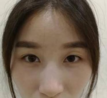 重庆西南医院王量医生双眼皮做得怎么样?真实案例反馈