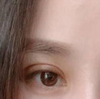 重庆西南医院王量医生双眼皮做得怎么样?真实案例反馈